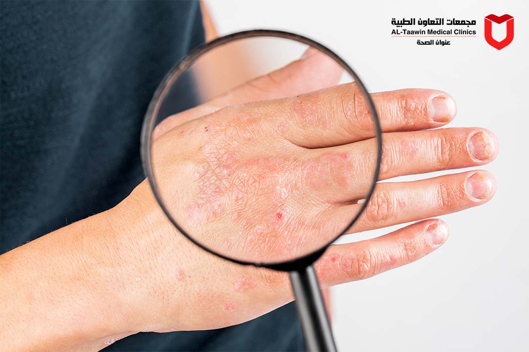 دليلك الشامل لتهدئة الإكزيما الجلدية والتخلص من الحكة نهائياً