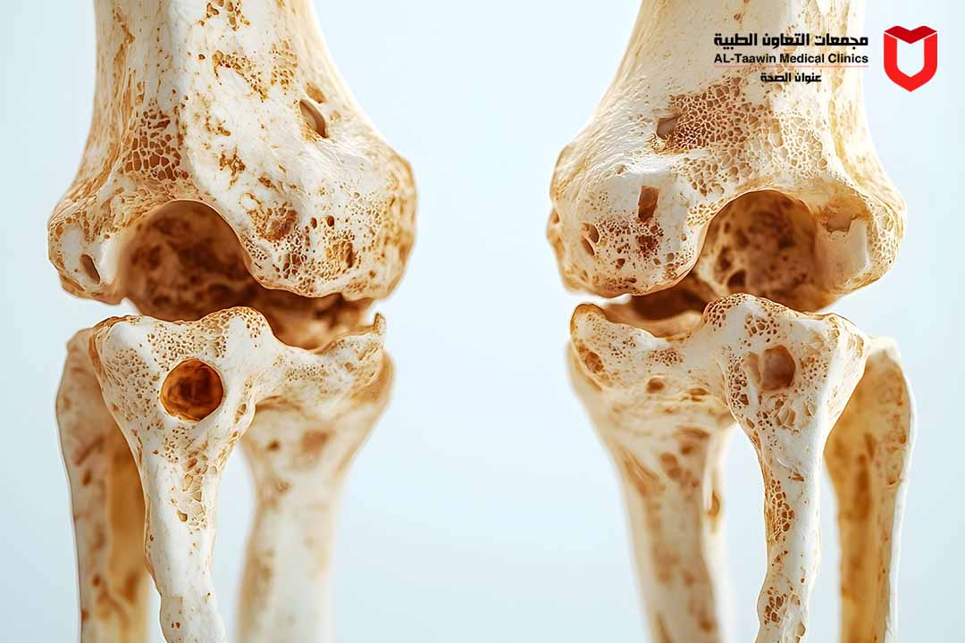 كل ما تود معرفته عن هشاشة العظام | كيف تحمي عظامك وكيف تعالجها؟