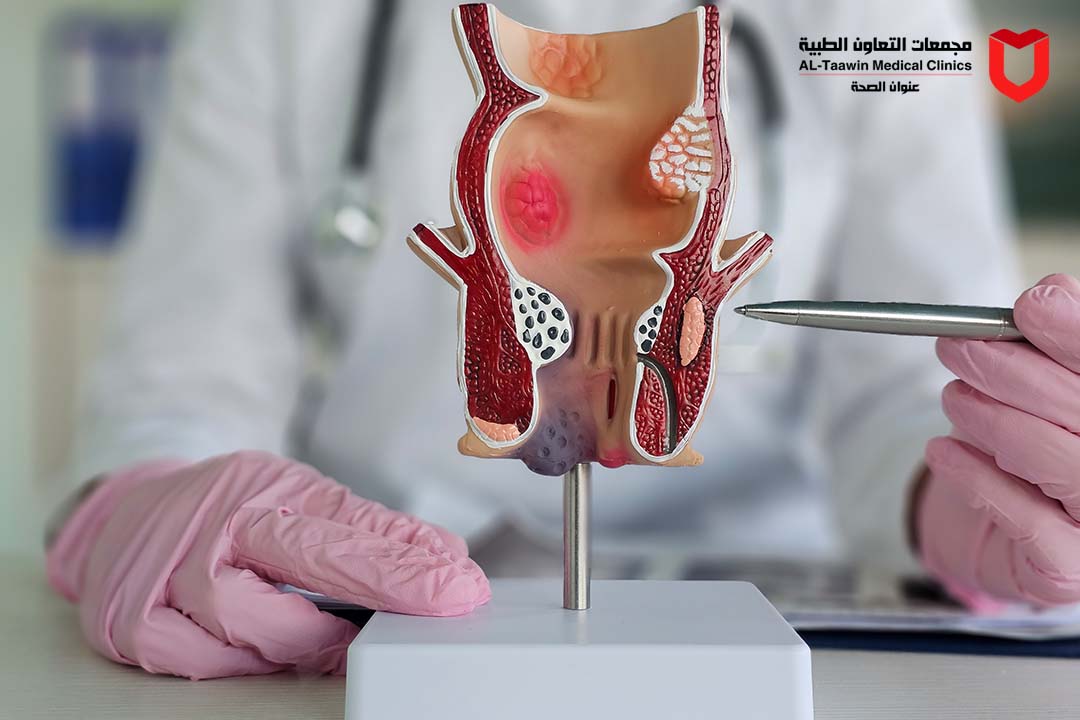 البواسير | كيف تعرف أعراضها؟ و طرق العلاج والوقاية