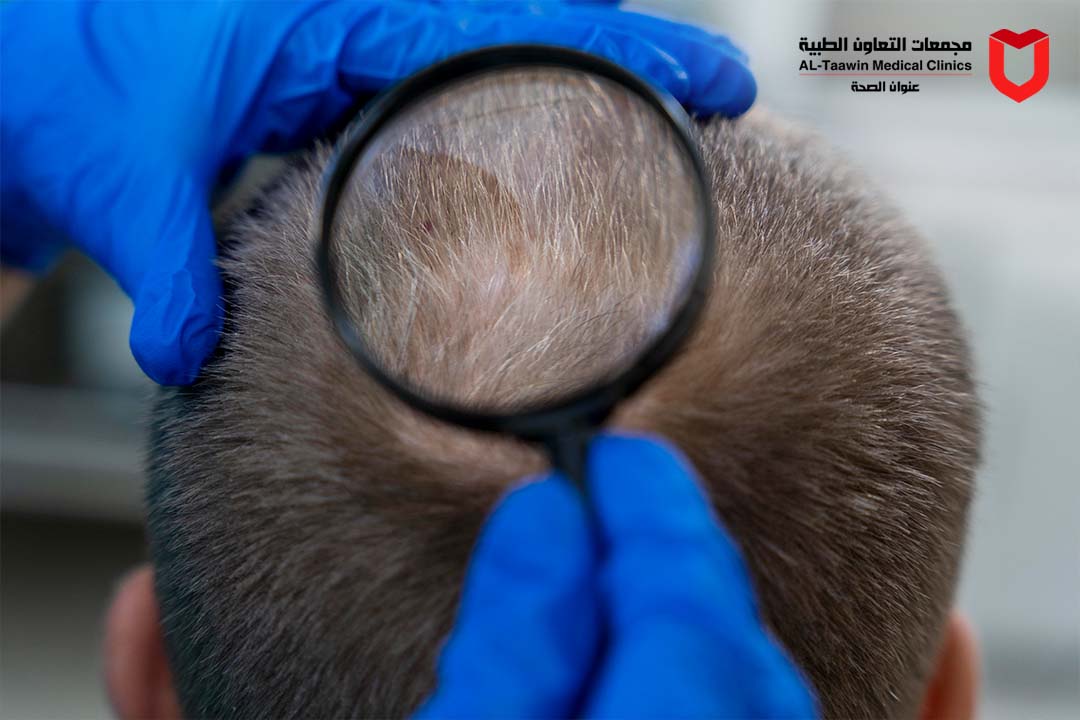 الثعلبة | الأسباب والعلاج و طرق استعادة نمو الشعر