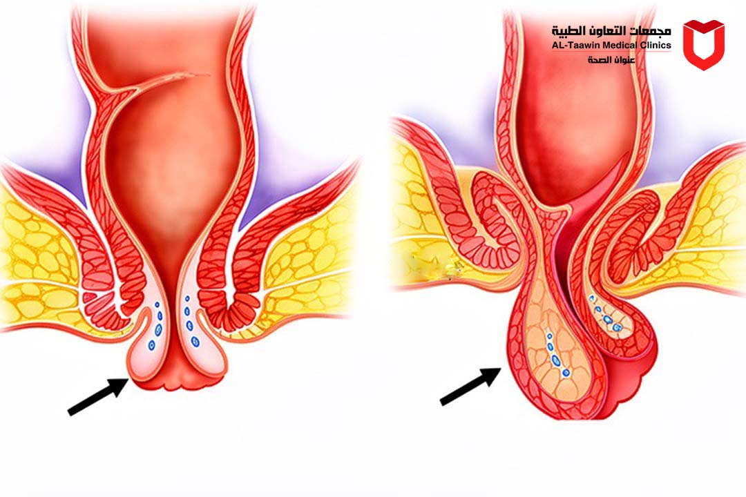 دليل الهبوط الشرجي: الأسباب، الأعراض، وأحدث طرق العلاج