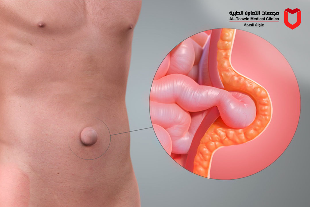 دليلك لمرض الفتق | الأسباب، الأعراض وأحدث طرق العلاج