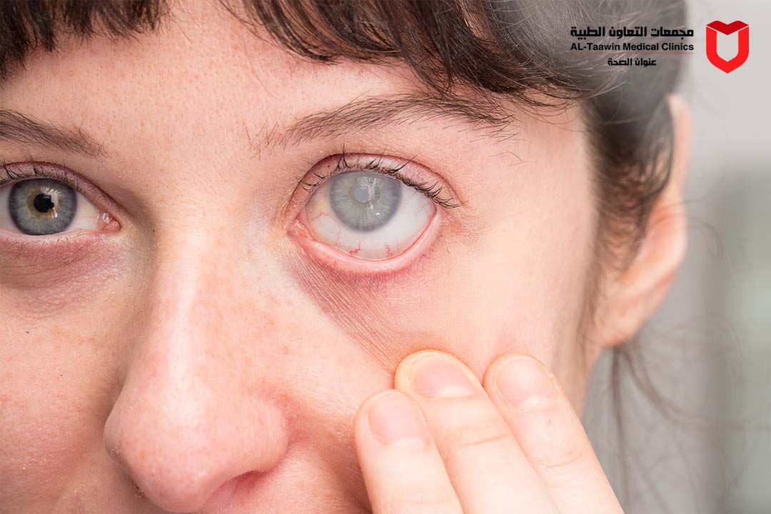 المياة البيضاء للعين | الأسباب والأعراض و طرق العلاج
