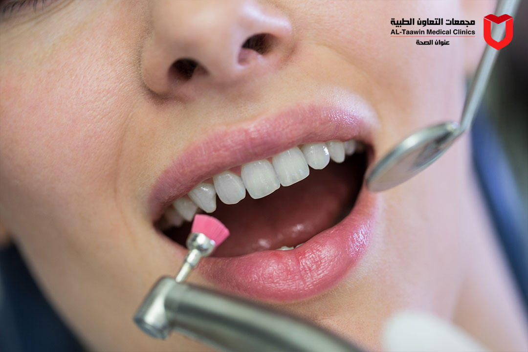 تبييض الأسنان | الطرق والأسباب وأحدث التقنيات لابتسامة مشرقة