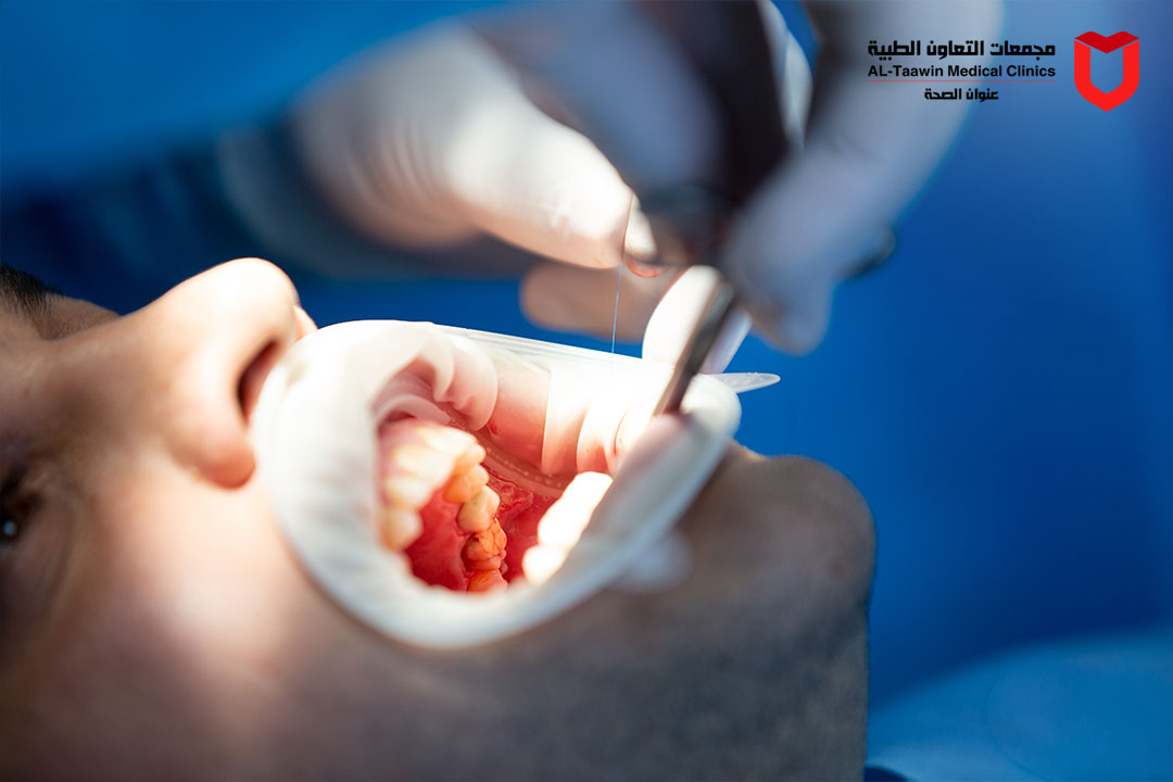 حشو عصب الاسنان | الخطوات، الأنواع، وتجنب الألم أثناء العلاج