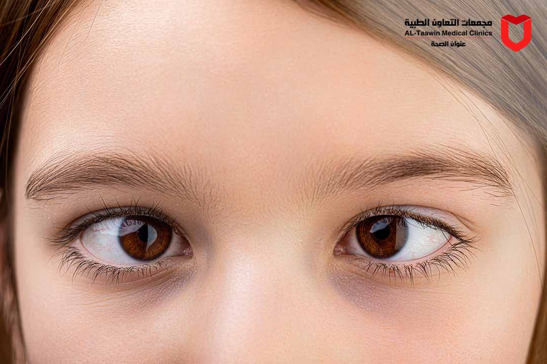 حول العين | الأعراض وطرق العلاج ومتى تحتاج إلى الطبيب؟