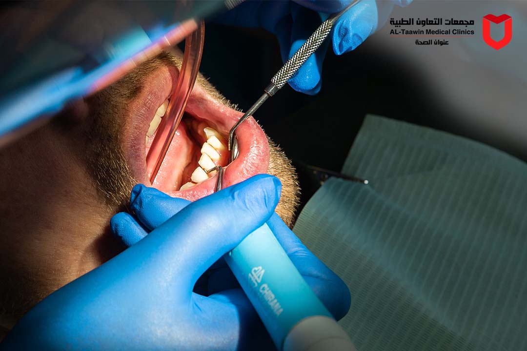 خلع ضرس العقل: الحل للتخلص من الألم ومضاعفاته