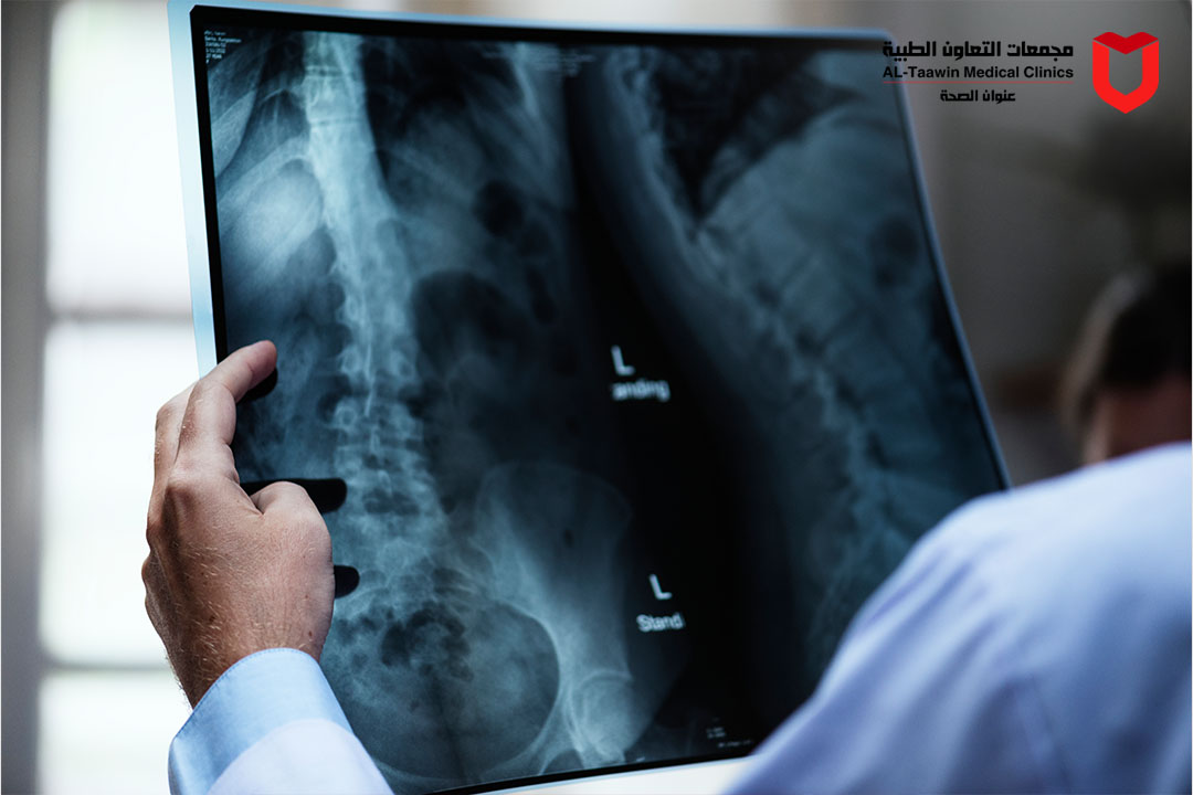 مرض الجنف (اعوجاج العمود الفقري): الأسباب، الأعراض، وطرق العلاج