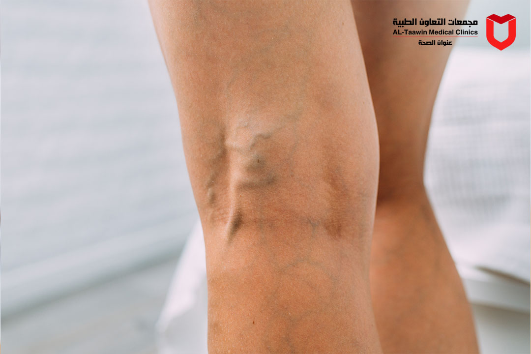 دليلك الشامل لـ علاج الدوالي | الأسباب والوقاية وأحدث طرق العلاج