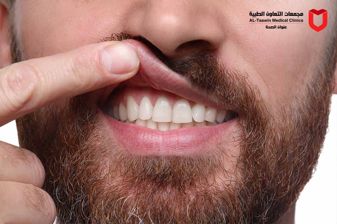 تراجع اللثة | أهم الأسباب والأعراض وطرق العلاج والوقاية
